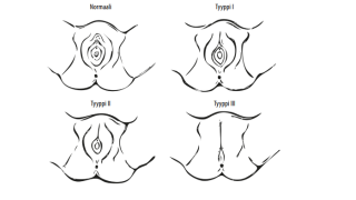 Eri silpomisen muodot